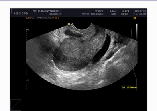  Preoperative Local Staging of Endometrial Cancer {faces}